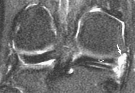 MR Imaging Of Meniscal Cysts Incidence Location And Clinical Significance AJR