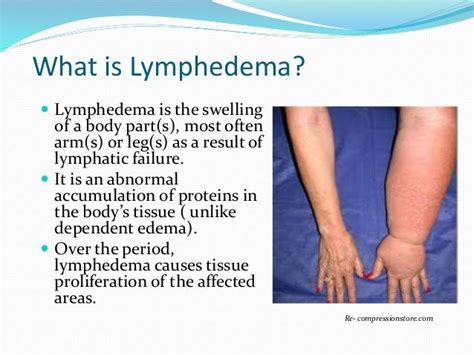 Stages Of Lymphedema