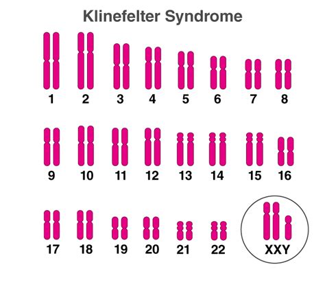 Symptoms Of Klinefelter Syndrome Diagram