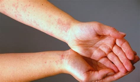 ما هي حساسية الجلد؟ وكيف نتوقاها؟ الميادين