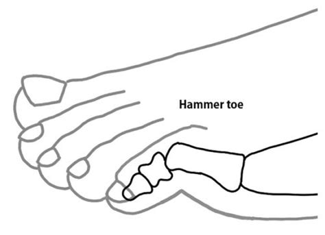 Hammertoe Treatment Guide Seattle Specialists