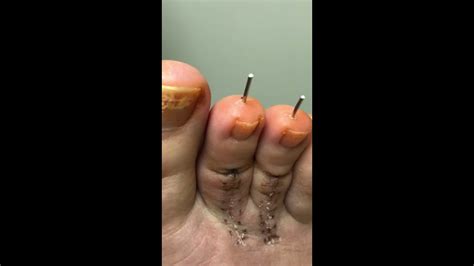 Dr Removing Pins From Toe Surgery Warning Graphic Youtube
