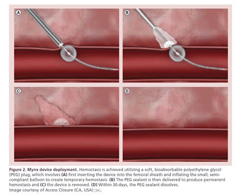 Femoral Arteriotomy Closure Using The Mynx Vascular Closure Device A