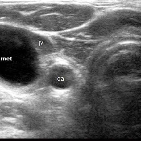 Ultrasound Image Of Enlarged Lymph Node In Level Iii Of The Right Neck