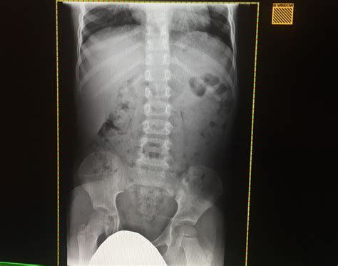 6 Yr Childs Abdominal X Ray Anything Wrong Rxrays