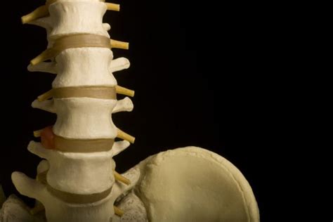 Facet Arthropathy And Spinal Arthritis Facty Health