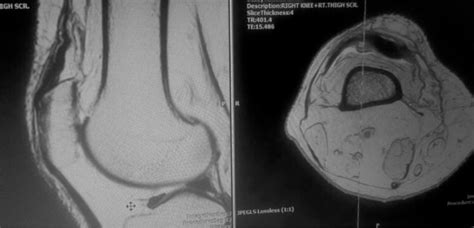 Quadriceps Tendon Tear MRI Sumer S Radiology Blog