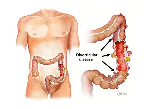 Race Humaine N Ud Se Plaindre Inflammation Sigmoid Colon Causes