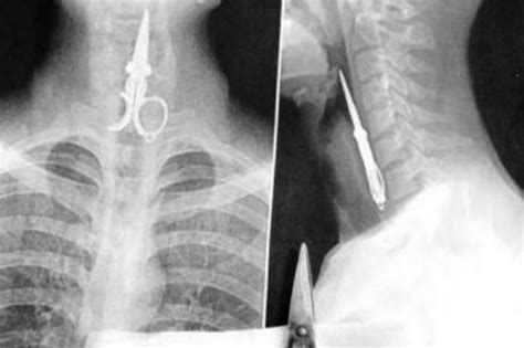 Incredible X Ray Of Scissors Stuck In Mans Throat Plus More Pics Of