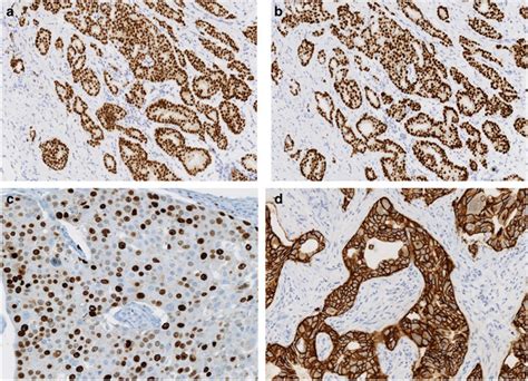 Immunohistochemical Expression Levels Of The Er Pgr Her2 And Ki67