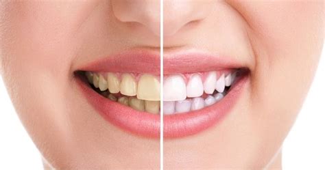 How Much Does Teeth Whitening Cost Everything To Know