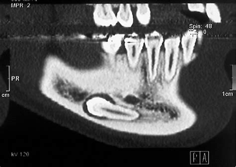 Figure From Transmigration Of Impacted Mandibular Canine To Opposite