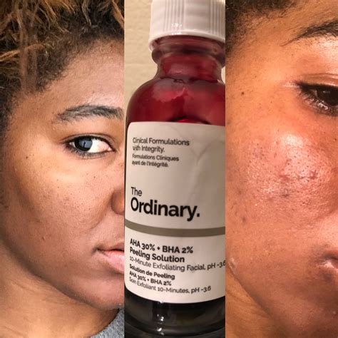 OMG! The Ordinary AHA Peeling Solution Did This To Me : SkinRevs