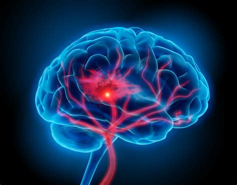 There are two broad categories of stroke: Stroke Brain Injury ABI TBI Seniors - vizuallyspeaking.ca