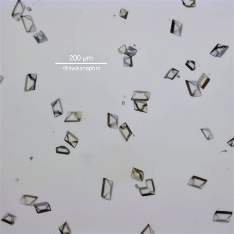 Urine Sediment Of The Month Common Crystals Renal Fellow Network