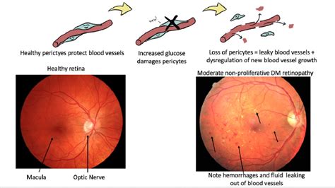 Diabetic Eye Exam Seerite Eye Clinic North York Toronto