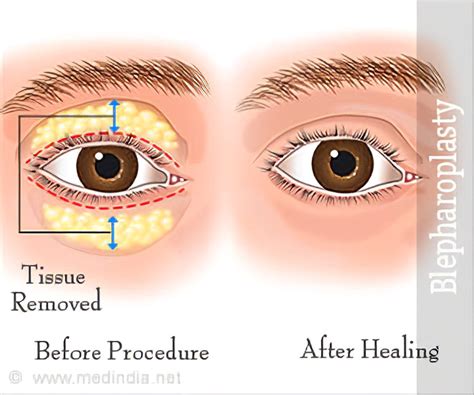 Upper Eyelid Surgery Ubicaciondepersonascdmxgobmx