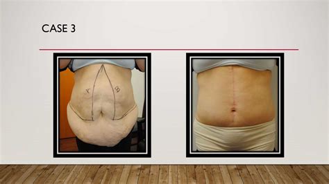 Tummy Tuck Abdominoplasty Before And After Photos Dr Anzarut