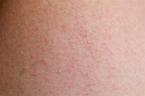 How To Dry Eczema Livestrongcom
