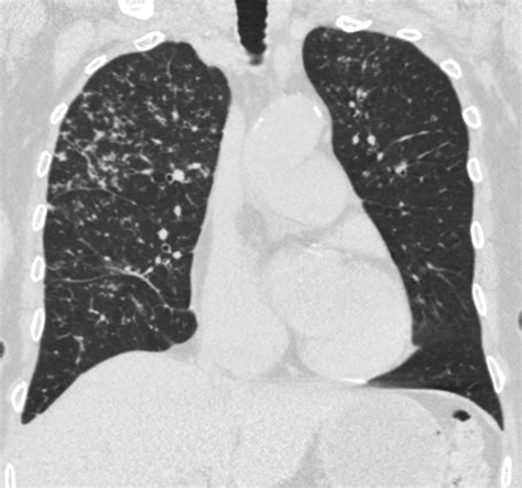 Tb Reactivation Lungs