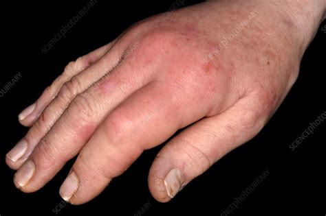 Cellulitis Of The Hand Stock Image C0426302 Science Photo Library