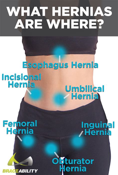 Hernia Symptoms Abdomen / Hiatal Hernia - Types of hernia 