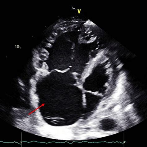Echocardiogram Four Chamber Views Showing Severely Dilated Right Atrium