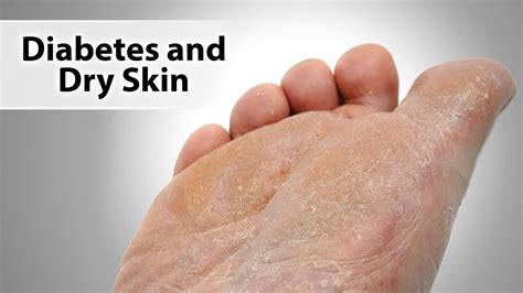 Diabetes And Dry Skin Youtube