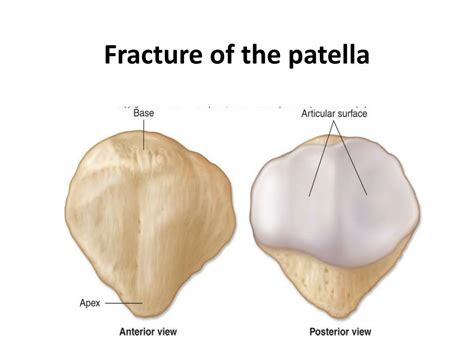 Ppt Fracture Of The Patella Powerpoint Presentation Id394804