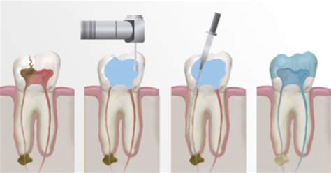 Numerosos han sido los medicamentos que se han empleado con este fin. Endodoncia en Sevilla - Dentista Sevilla