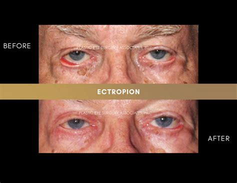 Ectropion Entropion Photos Plastic Eye Surgery Associates