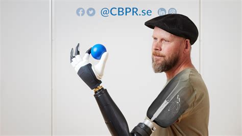 Above The Elbow Amputee ‘moves Individual Fingers In Bionic Limb In