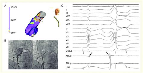 A Representative Case Of Pvc Ablated Successfully Within Rvot Below The