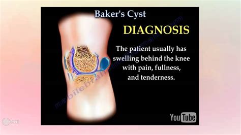 Baker S Cyst Youtube