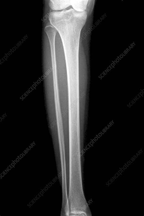 Lower Leg Bones X Ray Stock Image C0017639 Science Photo Library