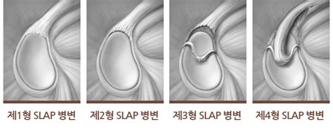 Slap Superior Labrum From Anterior To Posterior 관절와순파열슬랩병변 장지은트레이너