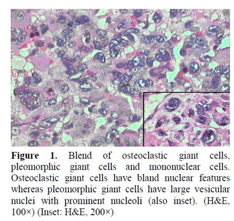 Combined Osteoclastic Giant Cell And Pleomorphic Giant Cell Tumor