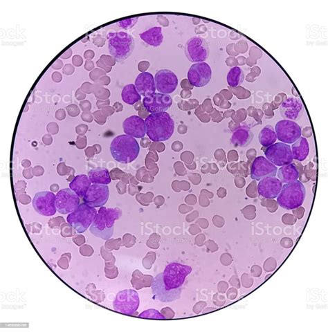 急性骨髄性白血病塗抹標本は単球と主に芽球細胞を示します貧血と血小板減少症 カラー画像のストックフォトや画像を多数ご用意 カラー画像