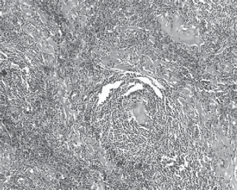 Microscopic View Of The Excised Portocaval Lymph Node The Follicles