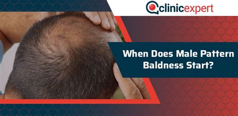 When Does Male Pattern Baldness Start ClinicExpert