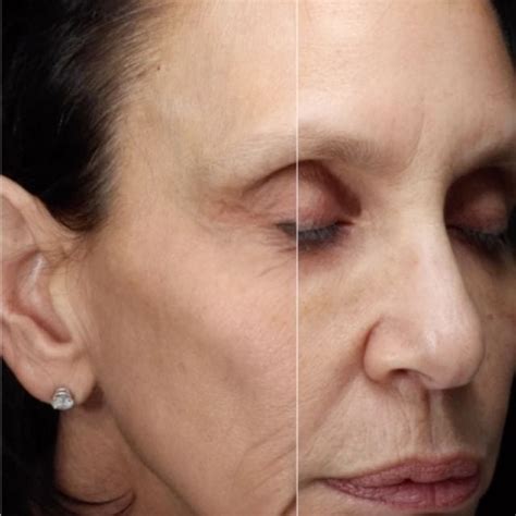 Unveiling A Radiant You Botox And Fillers Services Hormone Replacement Therapy And Sadhna