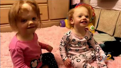 Formerly Conjoined Twins Now Thriving Following High Tech Surgery Cbs