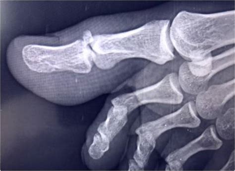 Distal Phalanx Fracture Toe