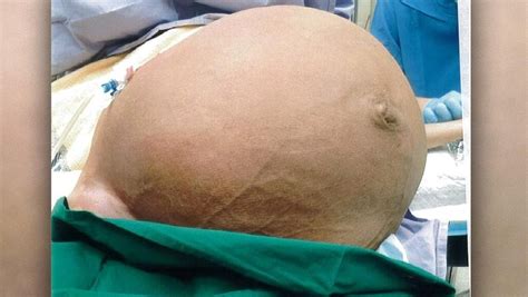 Doctors Remove Massive 28kg Tumour From Womans Uterus Daily Telegraph
