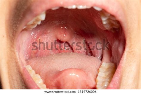 Sore Throat Throat Swollen Closeup Open 스톡 사진지금 편집 1319726006