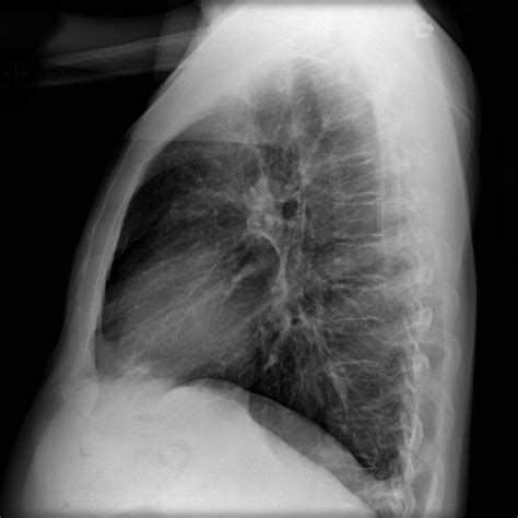 Respiratory Bronchiolitis Interstitial Lung Disease Image