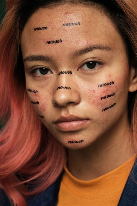 This Photographer Takes Beautiful Portraits Of People With Acne Vice