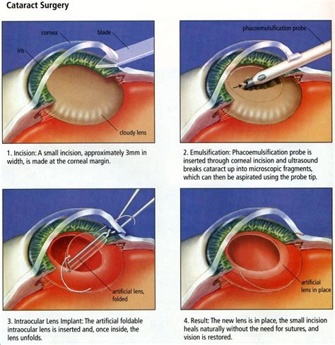 As with other types of cataract surgery, this is an outpatient procedure. Cataract Surgery: What is it, how does it work?