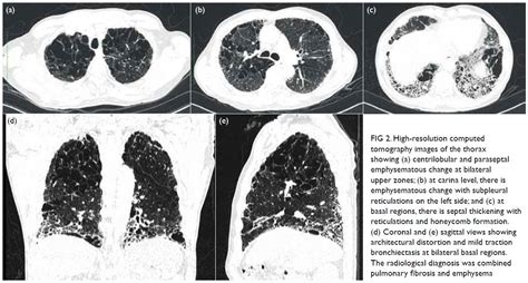 Combined Pulmonary Fibrosis And Emphysema A Commonly Missed Diagnosis