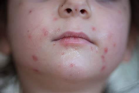 Meningitis Rash On Face From Meningitis To Eczema And Measles The Ultimate Baby Rash Guide And